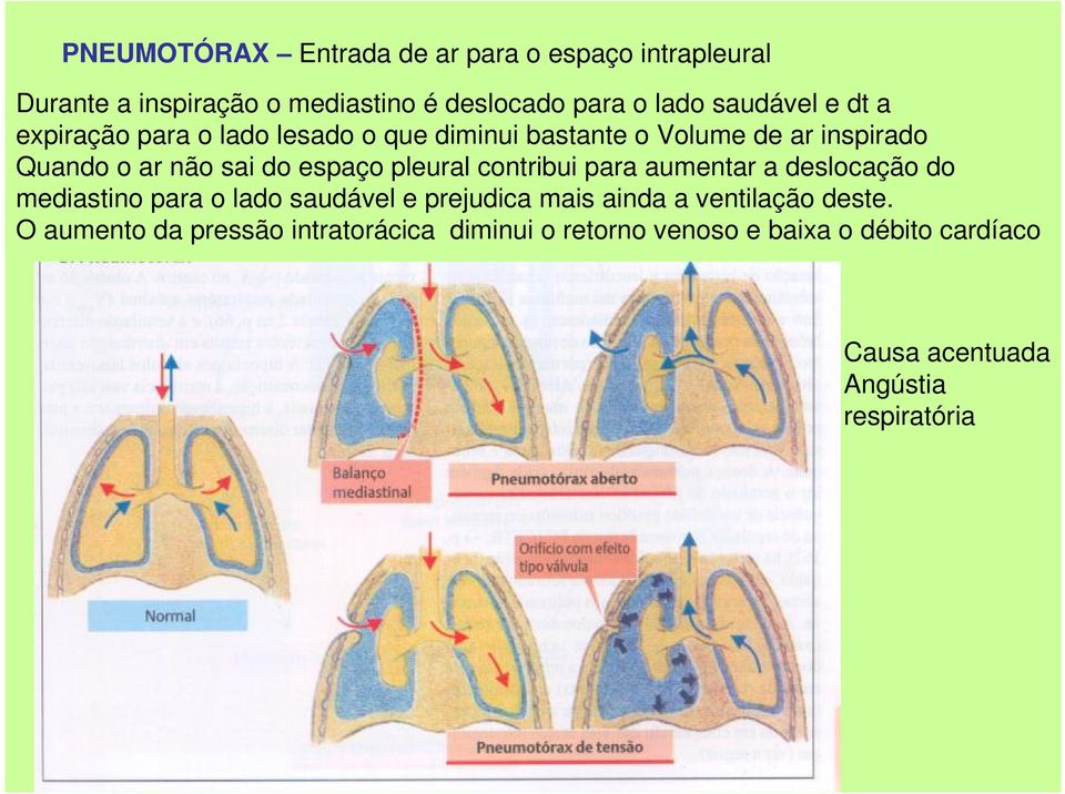 pleural contribui para aumentar a deslocação do mediastino para o lado saudável e prejudica mais ainda a ventilação