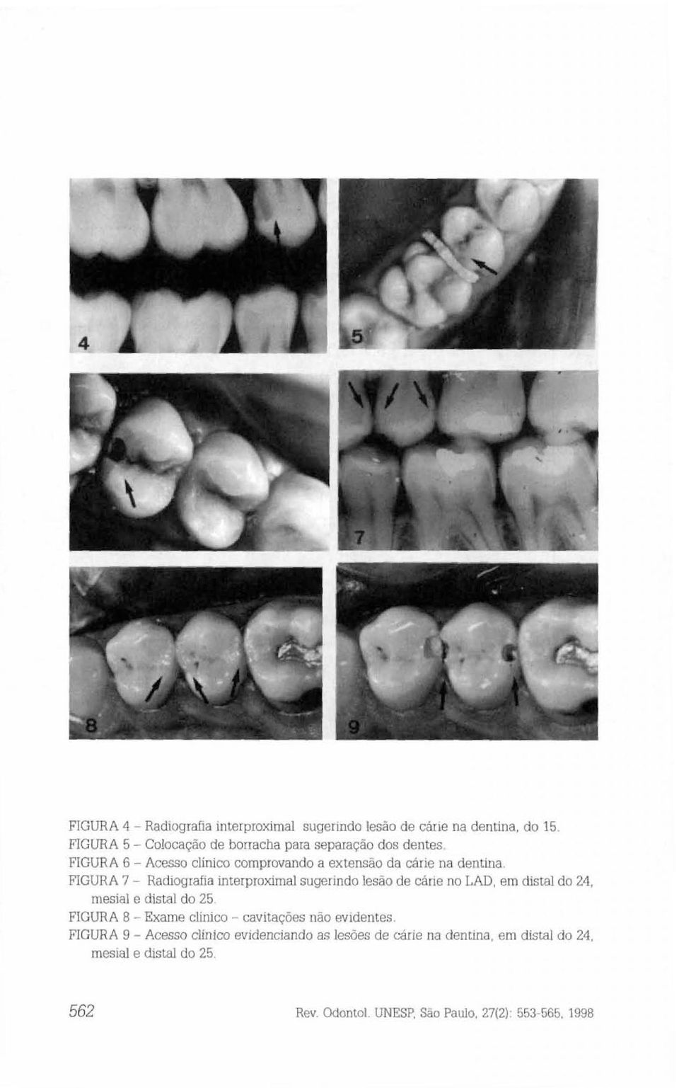 FIGURA 7 - Radiografia interproximal sugerindo lesão de cárie no LAD. em distal do 24, mesial e distal do 25.