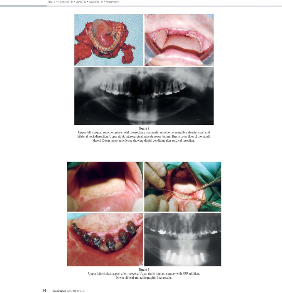 Upper right: microsurgical miocutaneous femural flap to cover floor of the mouth defect.