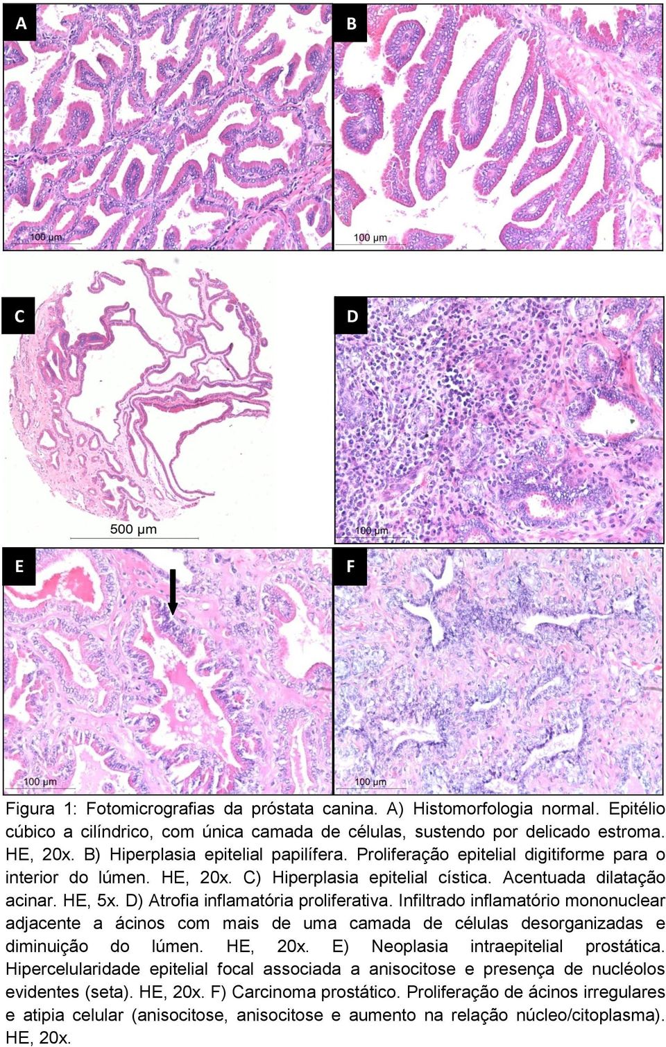 D) Atrofia inflamatória proliferativa. Infiltrado inflamatório mononuclear adjacente a ácinos com mais de uma camada de células desorganizadas e diminuição do lúmen. HE, 20x.