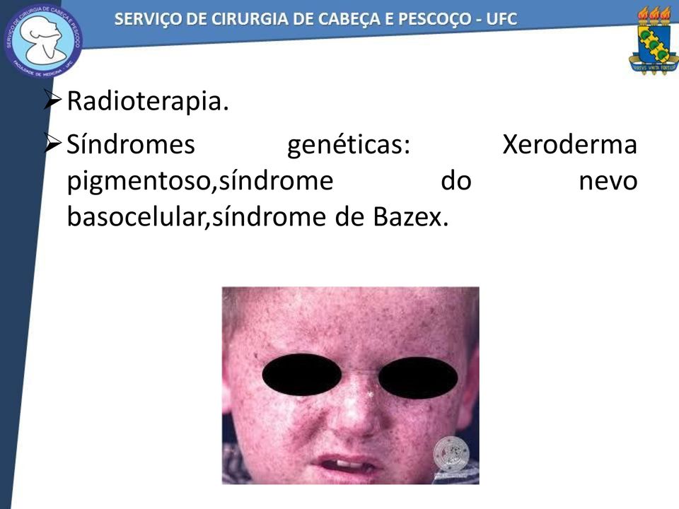 Xeroderma