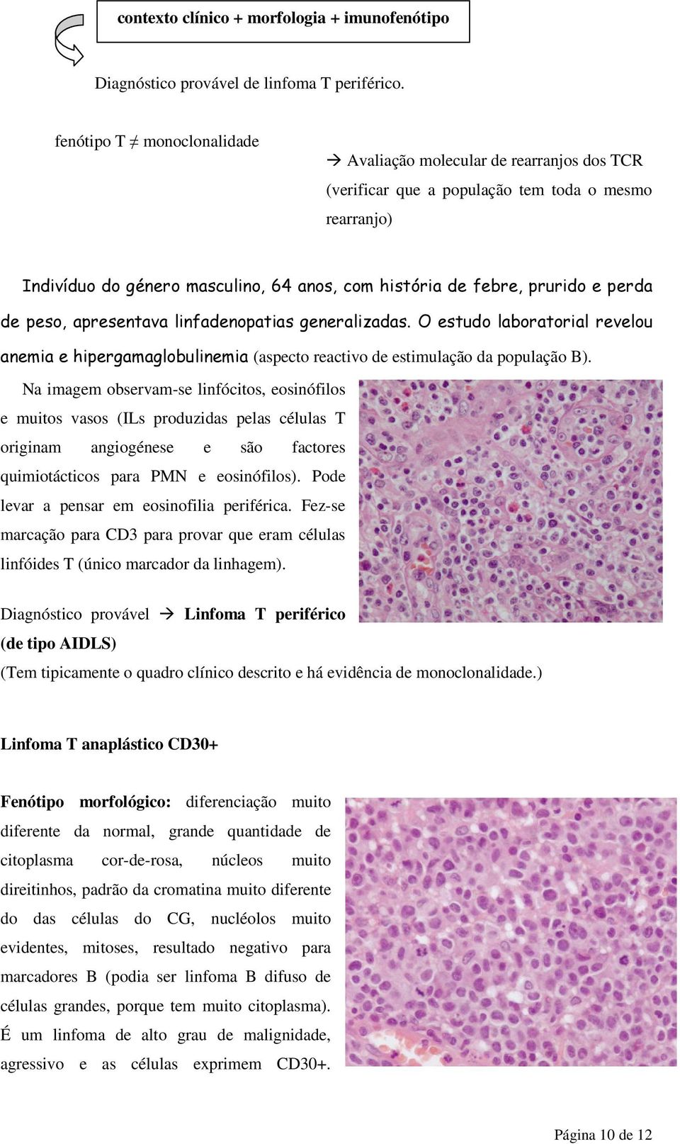 perda de peso, apresentava linfadenopatias generalizadas. O estudo laboratorial revelou anemia e hipergamaglobulinemia (aspecto reactivo de estimulação da população B).