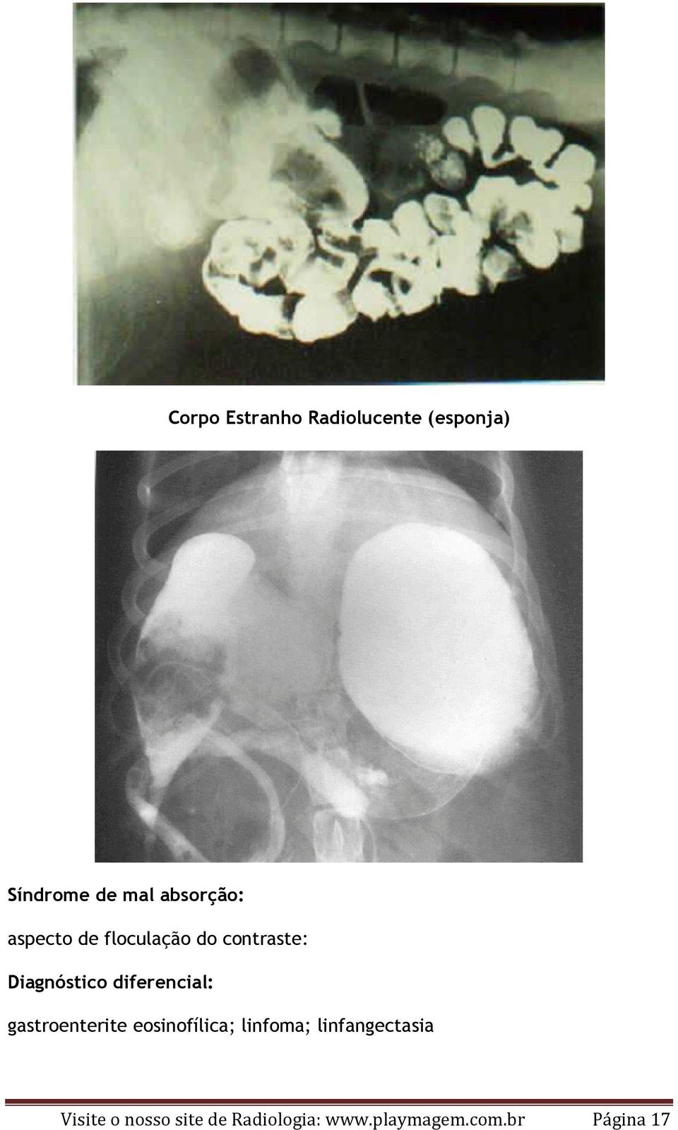 diferencial: gastroenterite eosinofílica; linfoma;