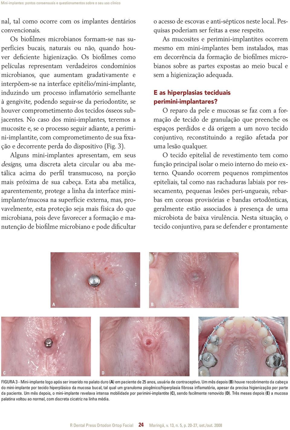 Os biofilmes como películas representam verdadeiros condomínios microbianos, que aumentam gradativamente e interpõem-se na interface epitélio/mini-implante, induzindo um processo inflamatório