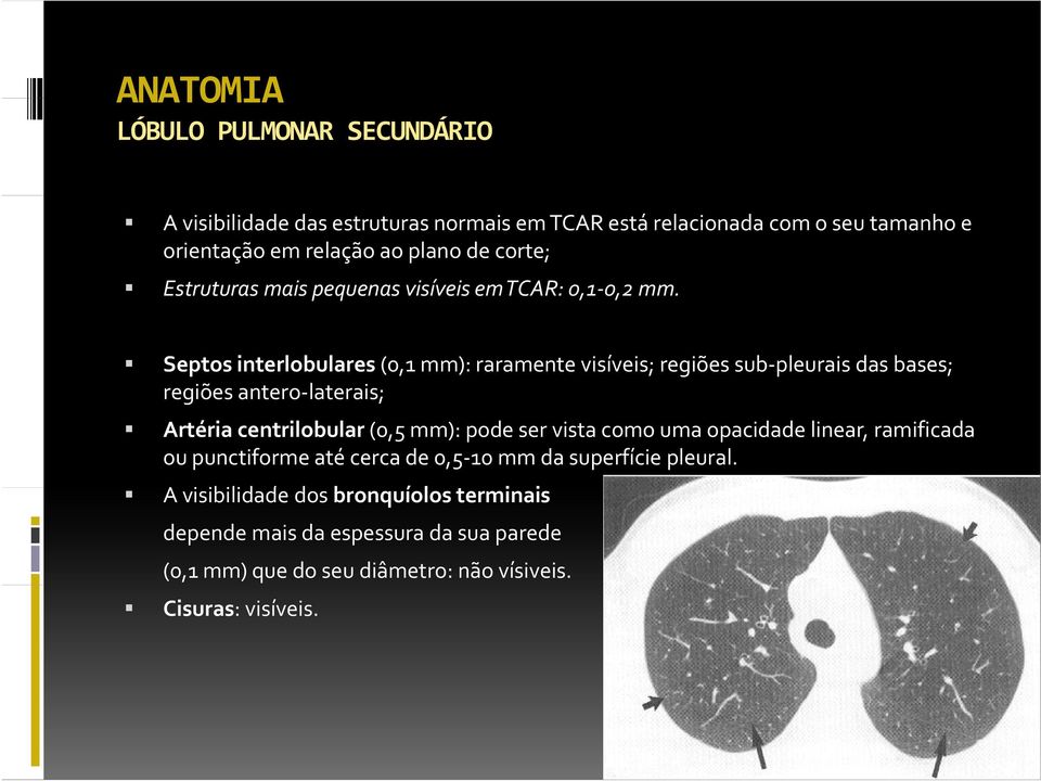 Septos interlobulares (0,1 mm): raramente visíveis; regiões sub pleurais das bases; regiões antero laterais; Artéria centrilobular (0,5 mm): pode ser vista