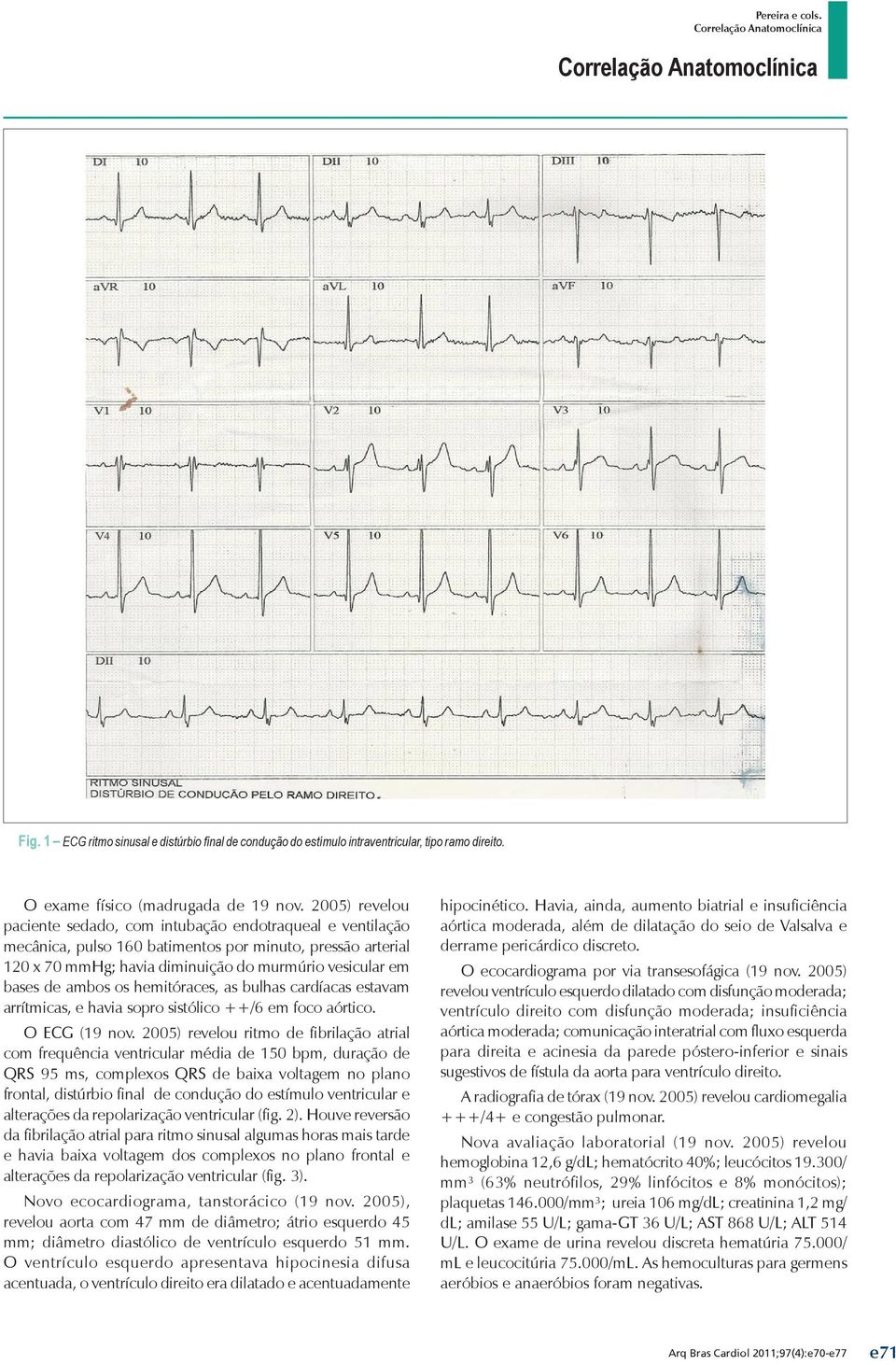 ambos os hemitóraces, as bulhas cardíacas estavam arrítmicas, e havia sopro sistólico ++/6 em foco aórtico. O ECG (19 nov.