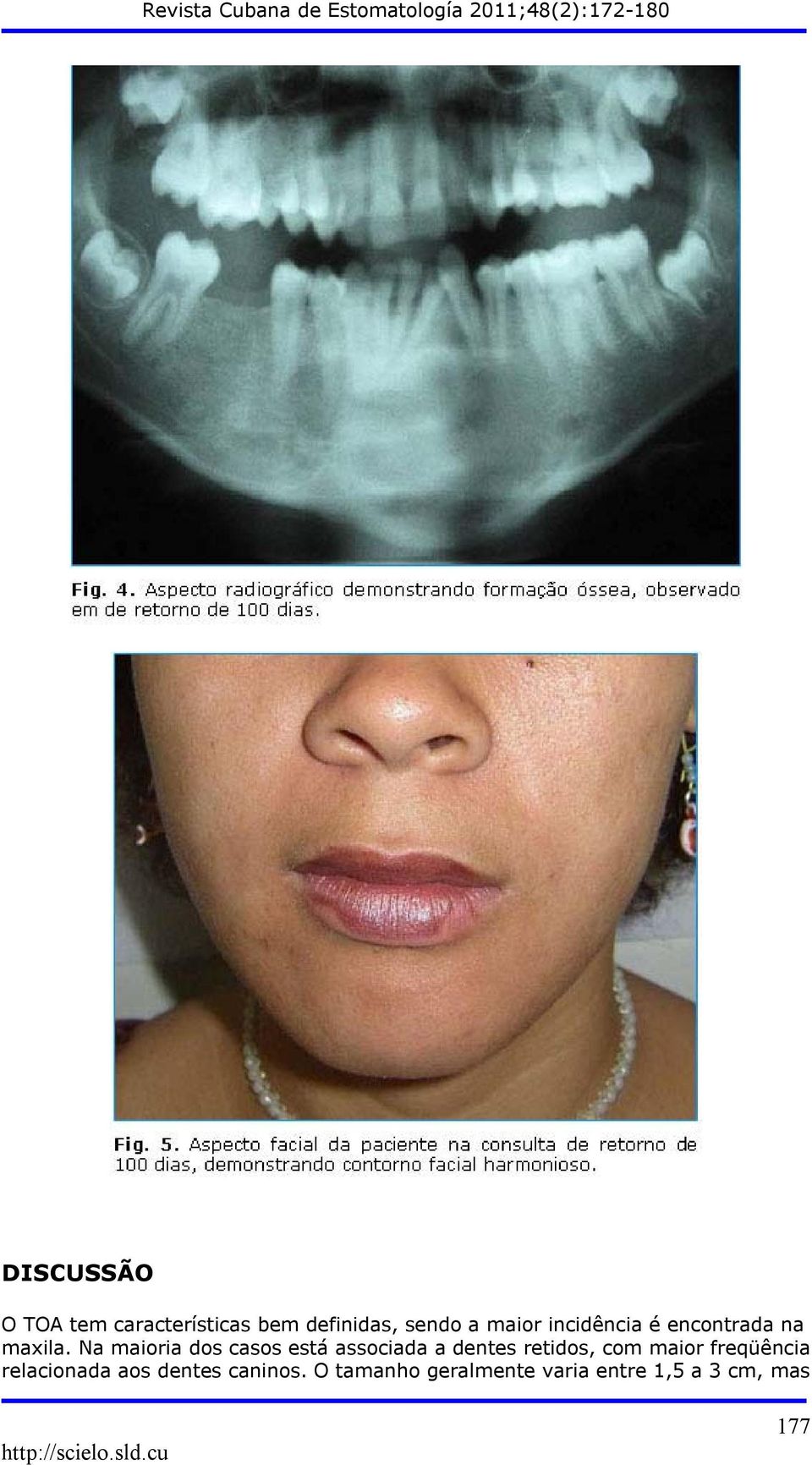 Na maioria dos casos está associada a dentes retidos, com maior