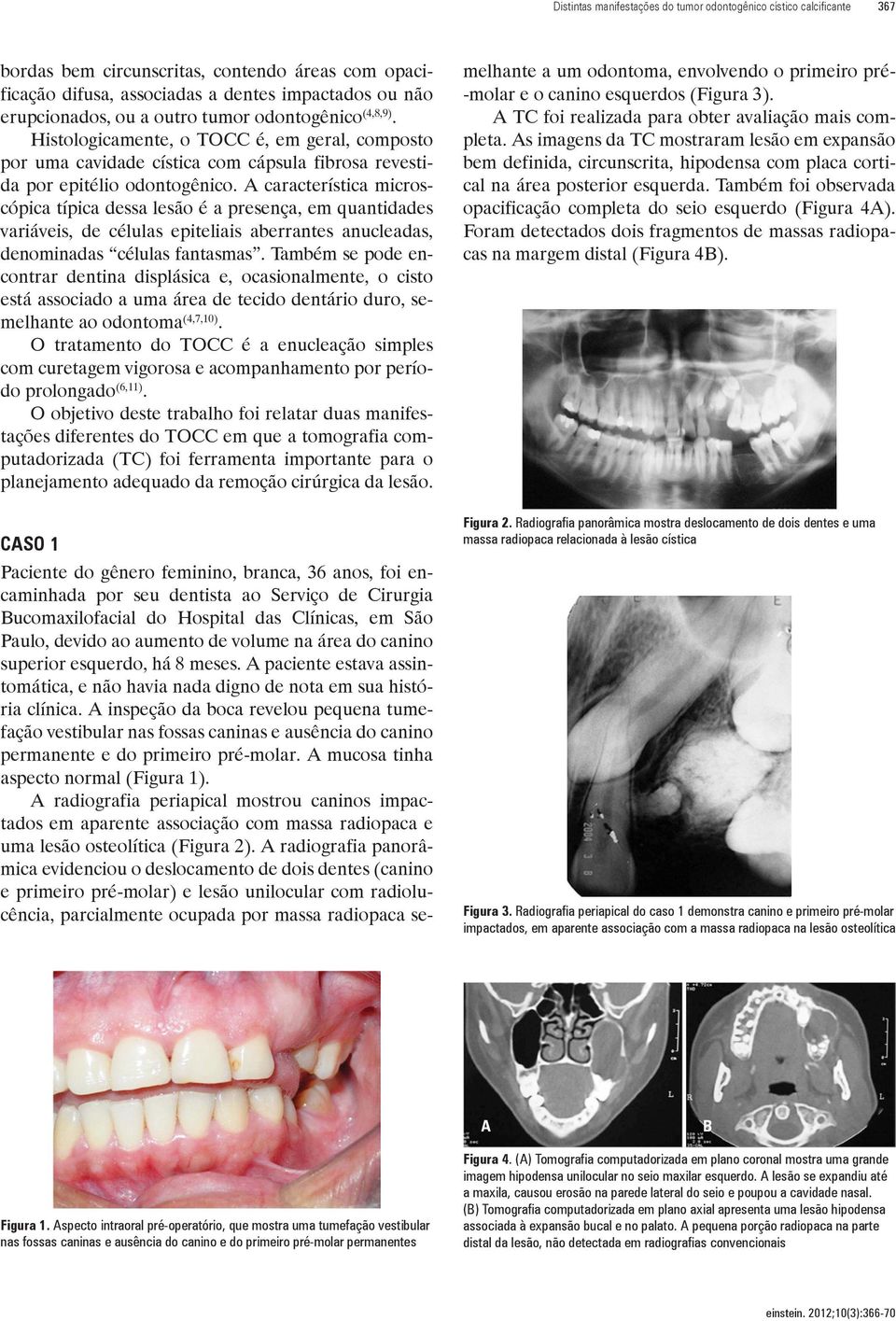 característica microscópica típica dessa lesão é a presença, em quantidades variáveis, de células epiteliais aberrantes anucleadas, denominadas células fantasmas.