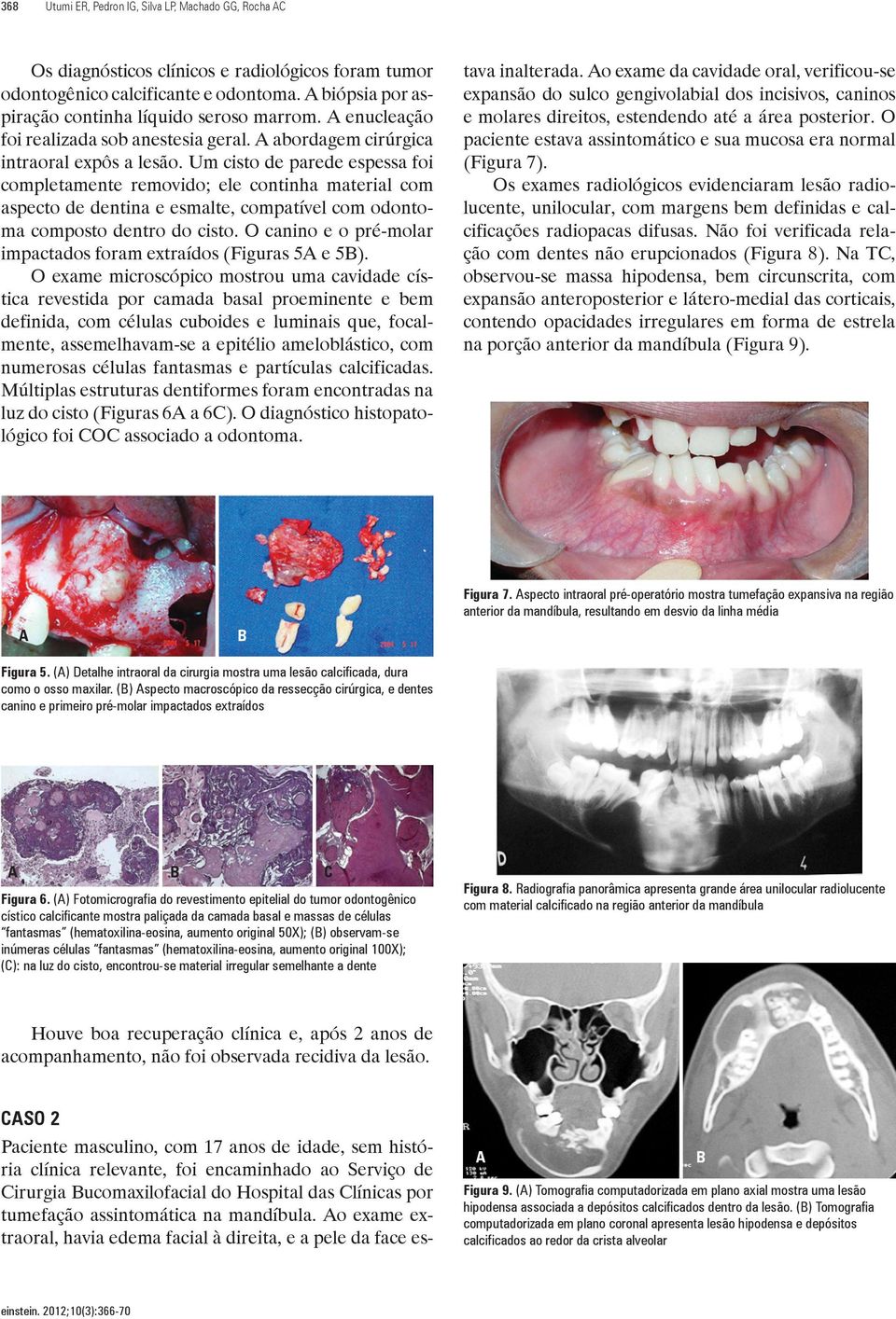 Um cisto de parede espessa foi completamente removido; ele continha material com aspecto de dentina e esmalte, compatível com odontoma composto dentro do cisto.