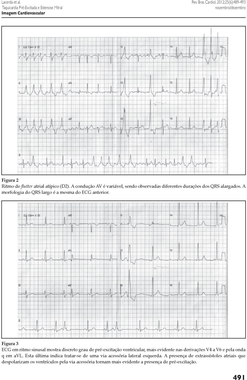 Figura 3 ECG em ritmo sinusal mostra discreto grau de pré-excitação ventricular, mais evidente nas derivações V4 a V6 e pela onda q