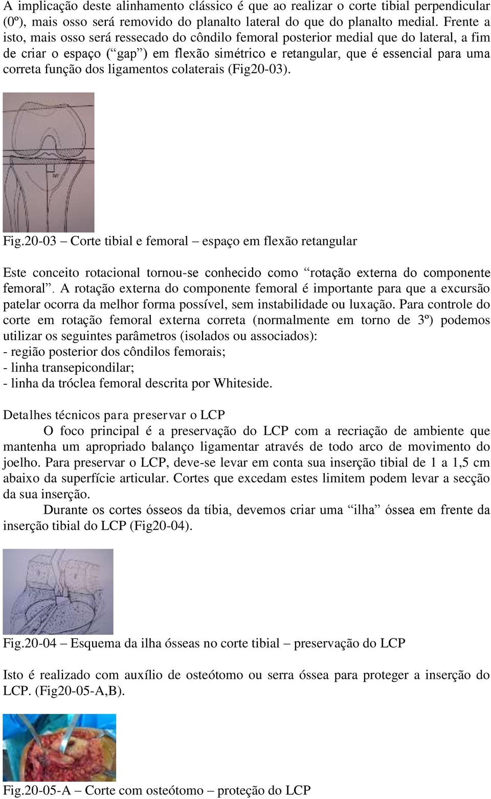 dos ligamentos colaterais (Fig20-03). Fig.20-03 Corte tibial e femoral espaço em flexão retangular Este conceito rotacional tornou-se conhecido como rotação externa do componente femoral.