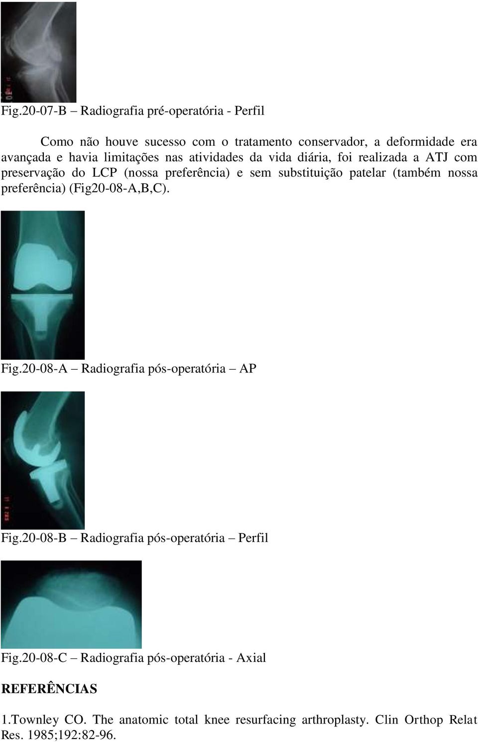 nossa preferência) (Fig20-08-A,B,C). Fig.20-08-A Radiografia pós-operatória AP Fig.20-08-B Radiografia pós-operatória Perfil Fig.