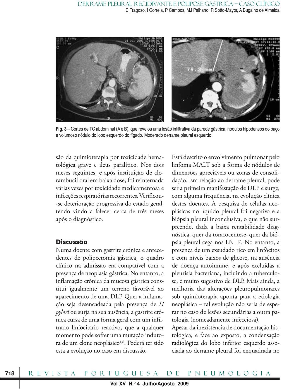 Nos dois meses seguintes, e após instituição de clorambucil oral em baixa dose, foi reinternada várias vezes por toxicidade medicamentosa e infecções respiratórias recorrentes.