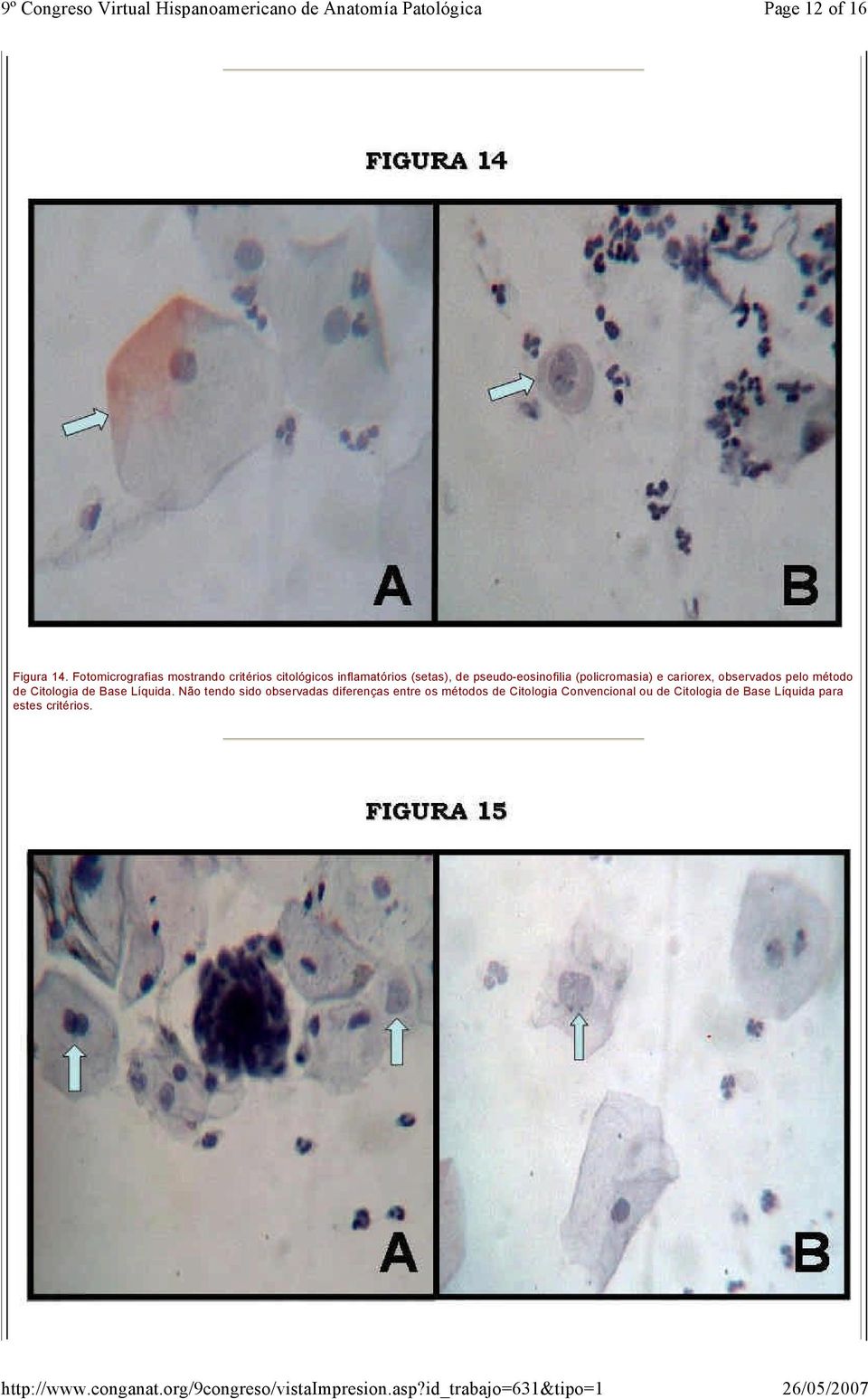 pseudo-eosinofilia (policromasia) e cariorex, observados pelo método de Citologia