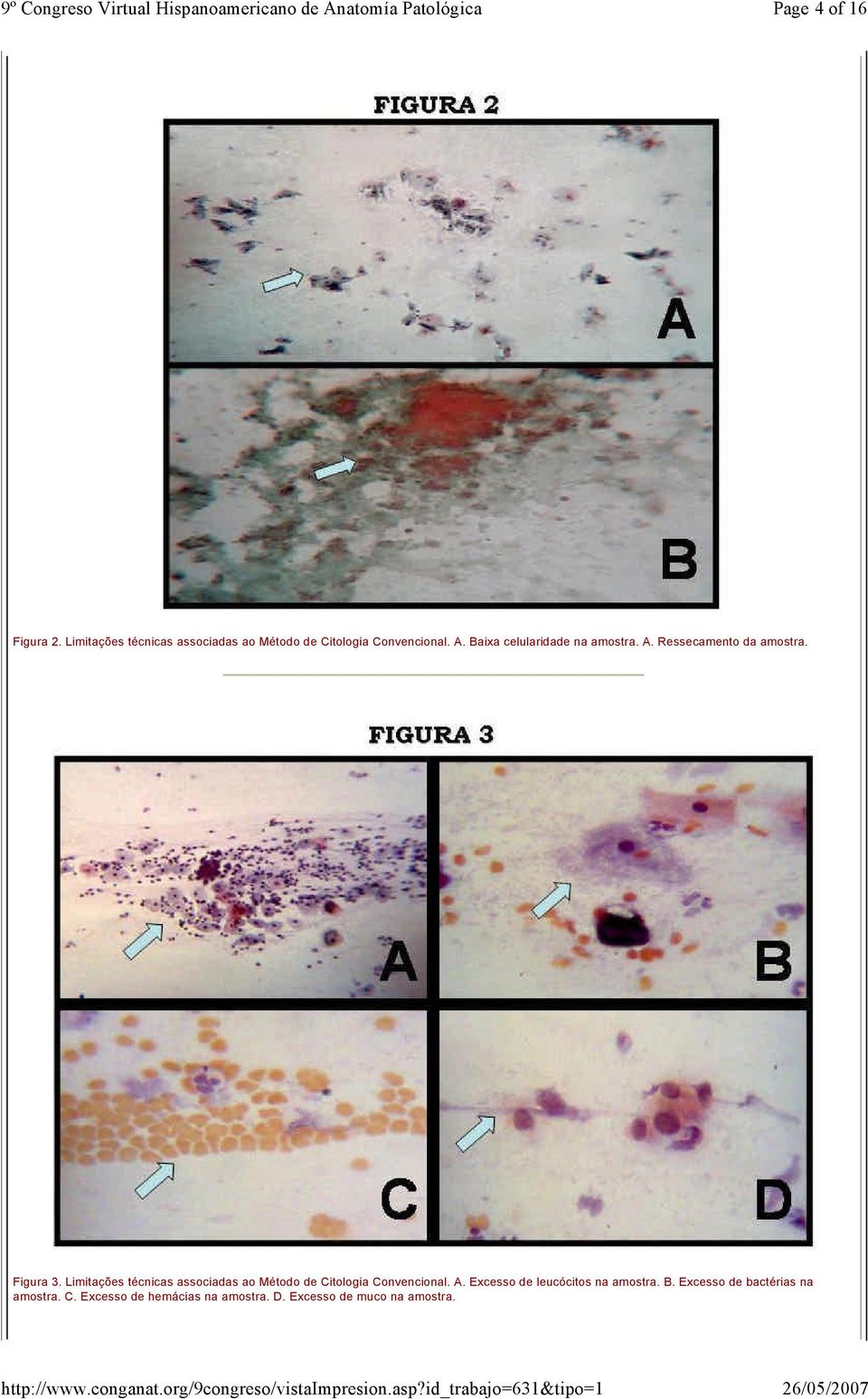 Limitações técnicas associadas ao Método de Citologia Convencional. A.