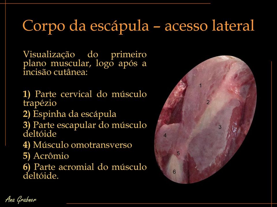 trapézio 2) Espinha da escápula 3) Parte escapular do músculo