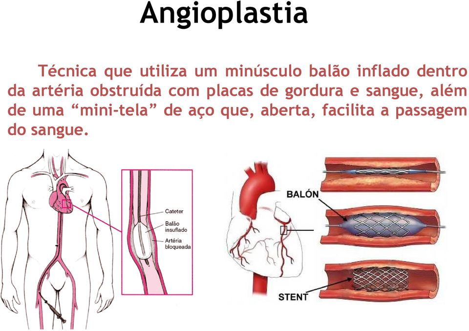 placas de gordura e sangue, além de uma