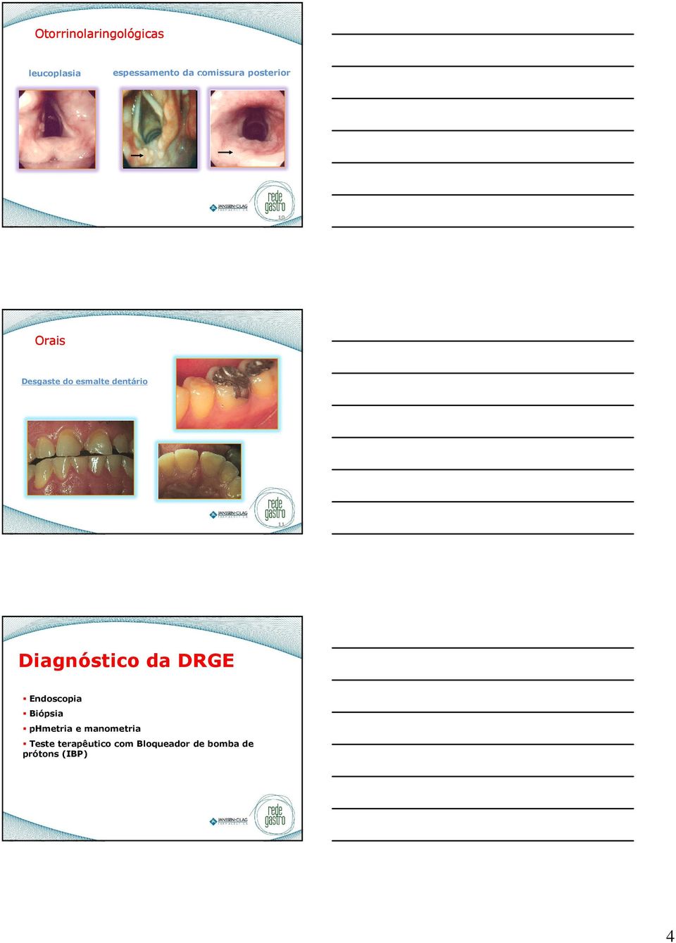 11 Diagnóstico da DRGE Endoscopia Biópsia phmetria e