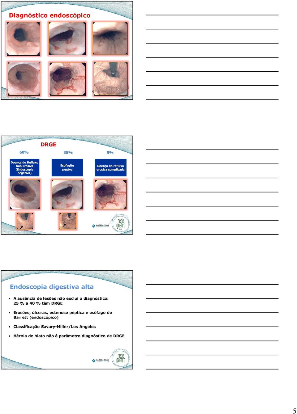 lesões não exclui o diagnóstico: 25 % a 40 % têm DRGE Erosões, úlceras, estenose péptica e esôfago de