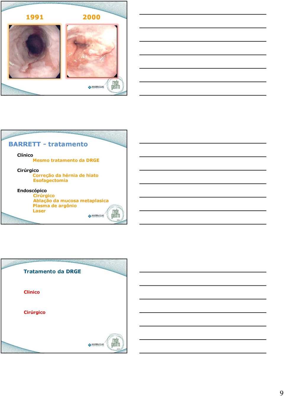 Endoscópico Cirúrgico Ablação da mucosa metaplasica Plasma