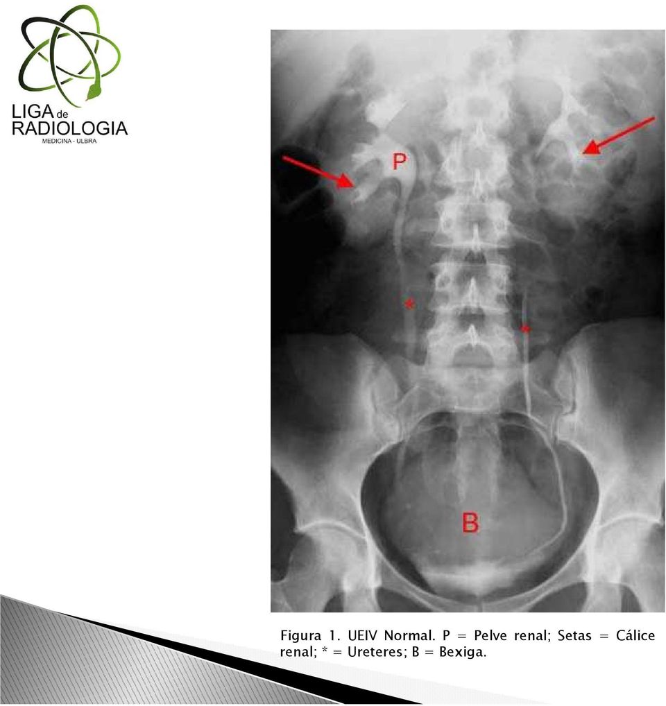 Setas = Cálice renal;