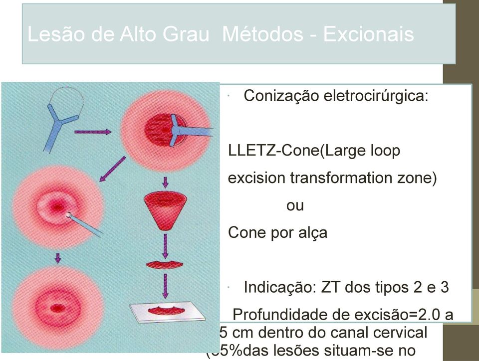 de Alto Grau Métodos - Excionais Conização eletrocirúrgica: