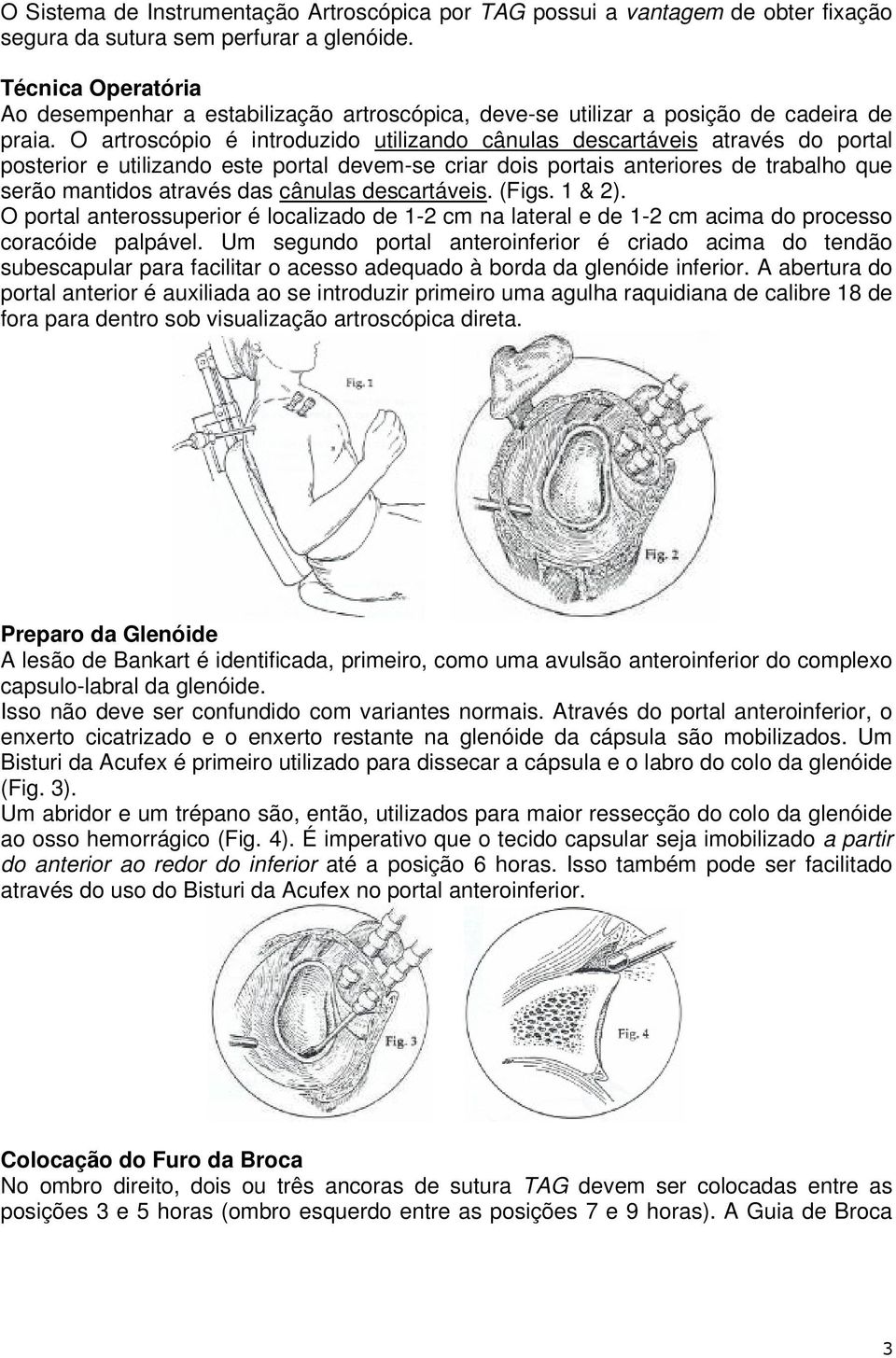 O artroscópio é introduzido utilizando cânulas descartáveis através do portal posterior e utilizando este portal devem-se criar dois portais anteriores de trabalho que serão mantidos através das