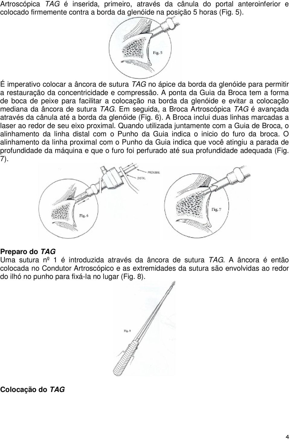 A ponta da Guia da Broca tem a forma de boca de peixe para facilitar a colocação na borda da glenóide e evitar a colocação mediana da âncora de sutura TAG.