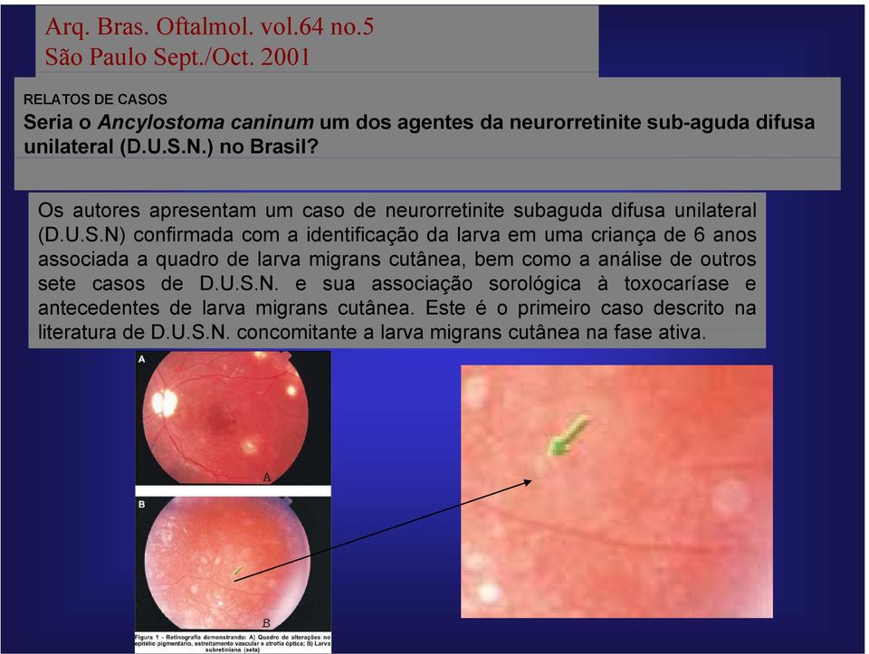 Os autores apresentam um caso de neurorretinite subaguda difusa unilateral (D.U.S.