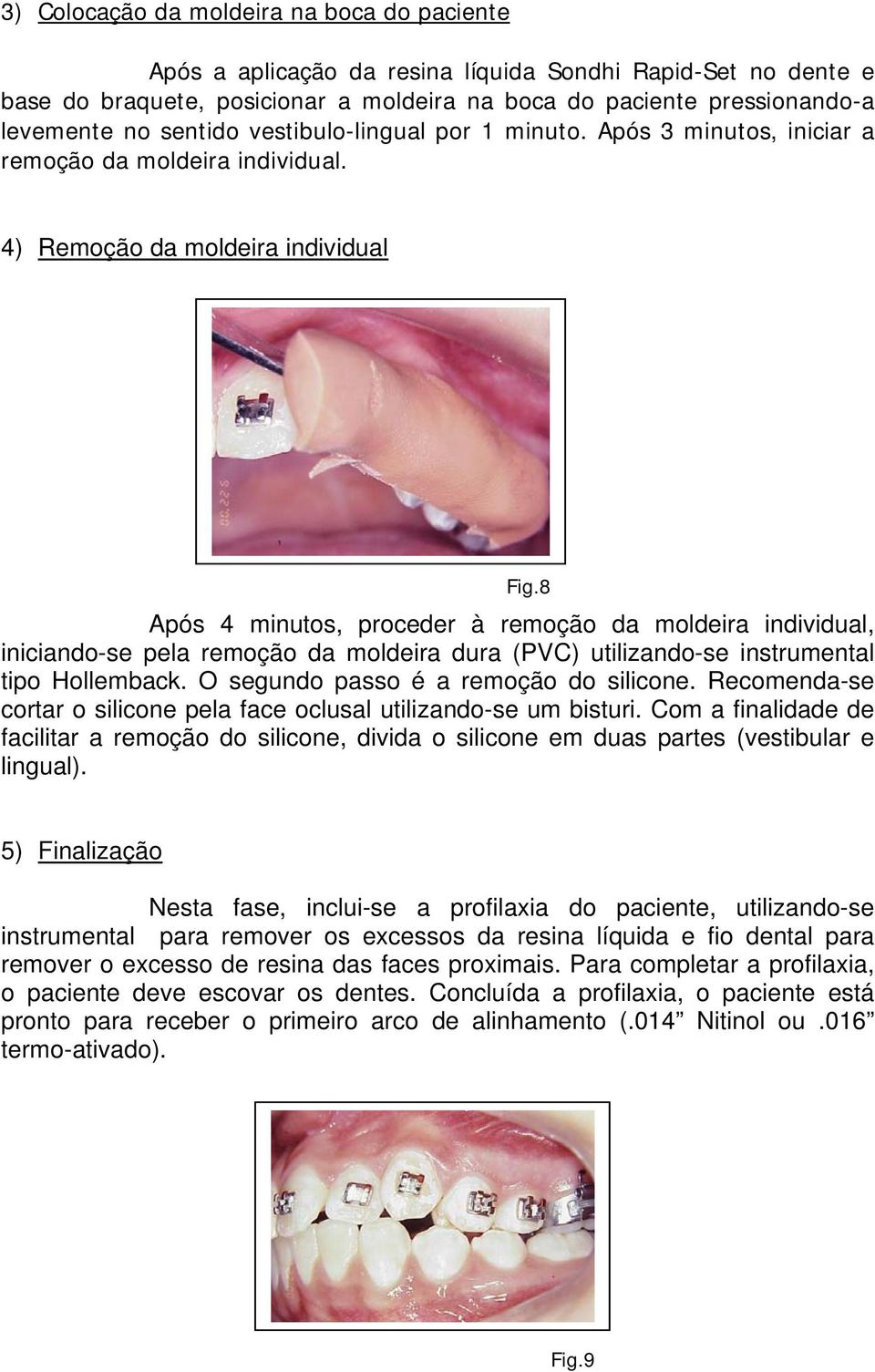 8 Após 4 minutos, proceder à remoção da moldeira individual, iniciando-se pela remoção da moldeira dura (PVC) utilizando-se instrumental tipo Hollemback. O segundo passo é a remoção do silicone.