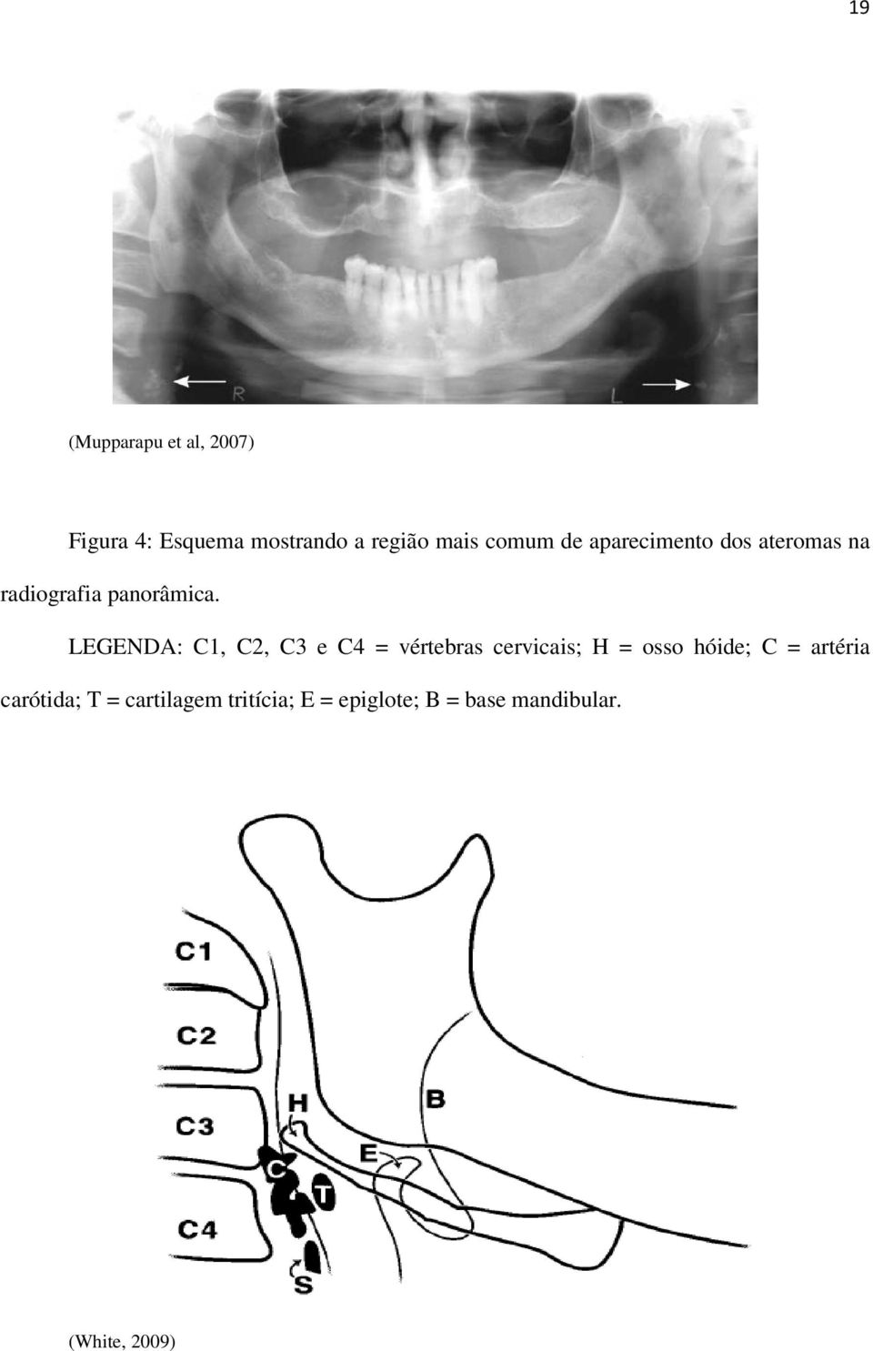 LEGENDA: C1, C2, C3 e C4 = vértebras cervicais; H = osso hóide; C =