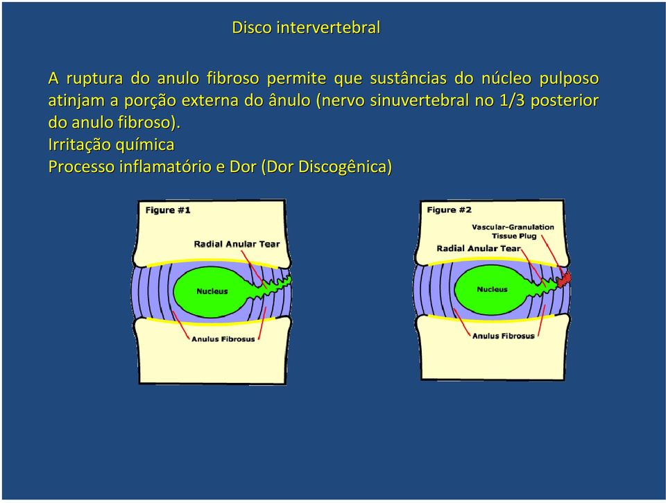 ânulo (nervo sinuvertebral no 1/3 posterior do anulo fibroso).