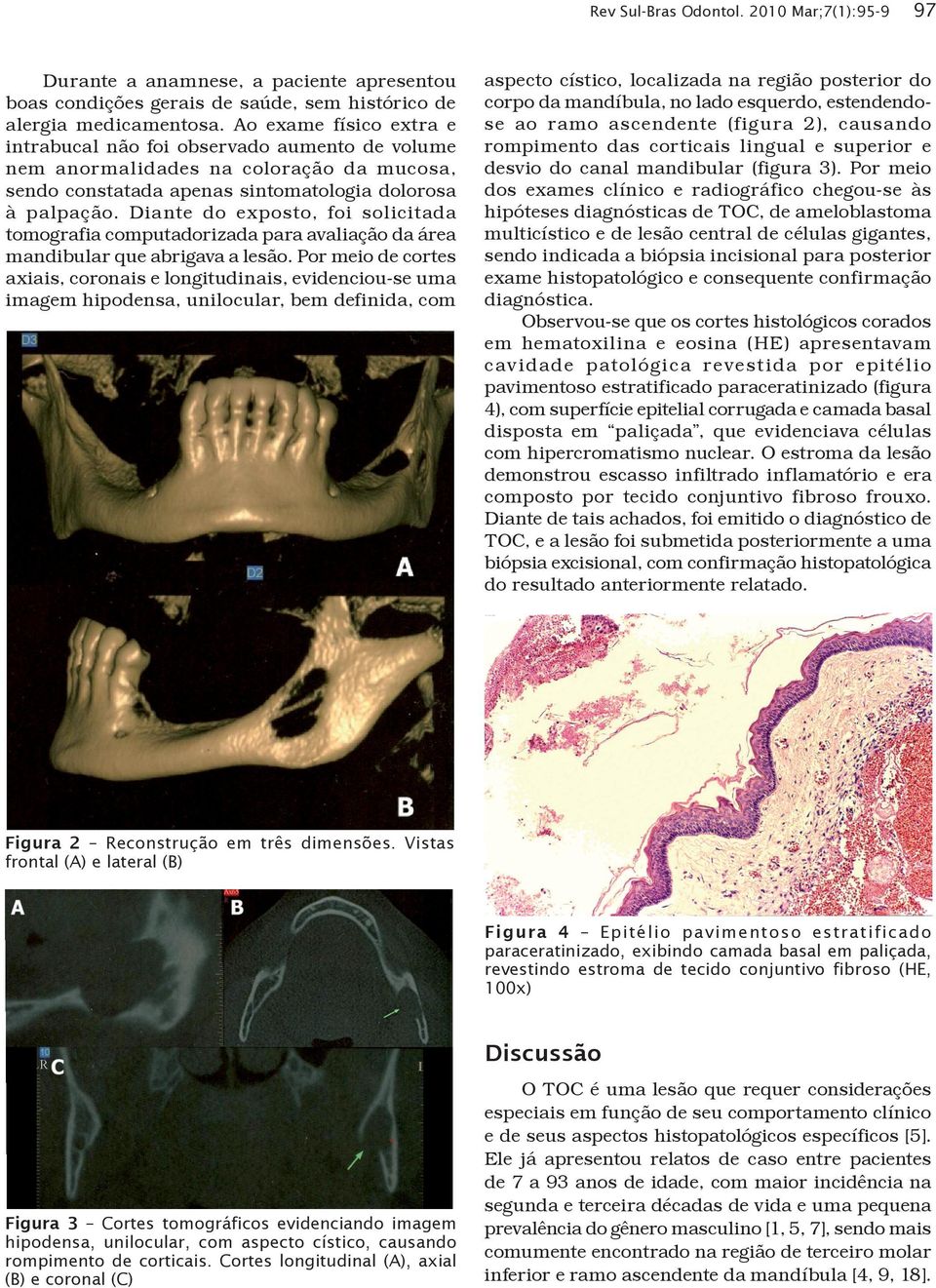 Diante do exposto, foi solicitada tomografia computadorizada para avaliação da área mandibular que abrigava a lesão.