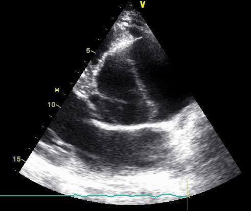 Dilatação da aorta ascendente Ectasia»» Aneurisma Risco de rotura e disseção ( diâmetros >60mm) Estudo complementar (angio-tc ou angio-rmn) se diâmetro >45mm