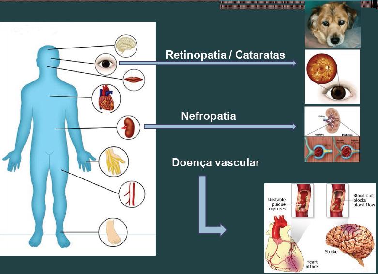 Diabetes Mellitus Doença dos 3 ps : Polifagia, Polidipsia, Poliúria - Tipo I diabetes insulino-dependente Antes dos 20 anos (homem) reacções auto-imunes contra os ilhéus, viroses - Tipo II diabetes