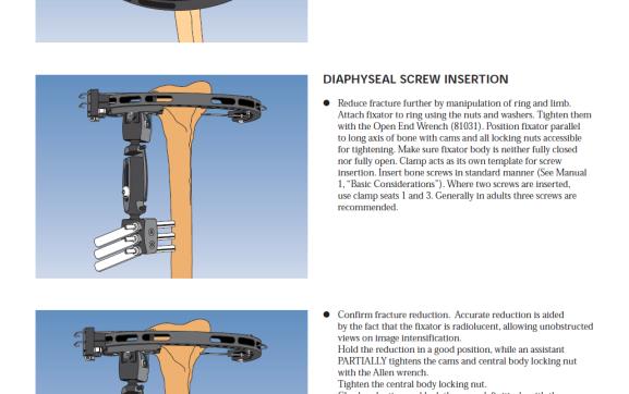 Inserção do parafuso na diáfise. Reduzir ainda mais a fratura pela manipulação do anel e membro. Anexar fixador de anel usando as porcas e arruelas.