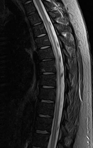 CASO CLÍNICO 2 Junho 2013 força muscular e alterações da sensibilidade nos membros inferiores com incapacidade de marcha 5 dias de MP endovenoso 1g/dia Sem benefício Exame Neurológico: Paraplegia