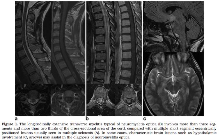 MRI in transverse myelitis.