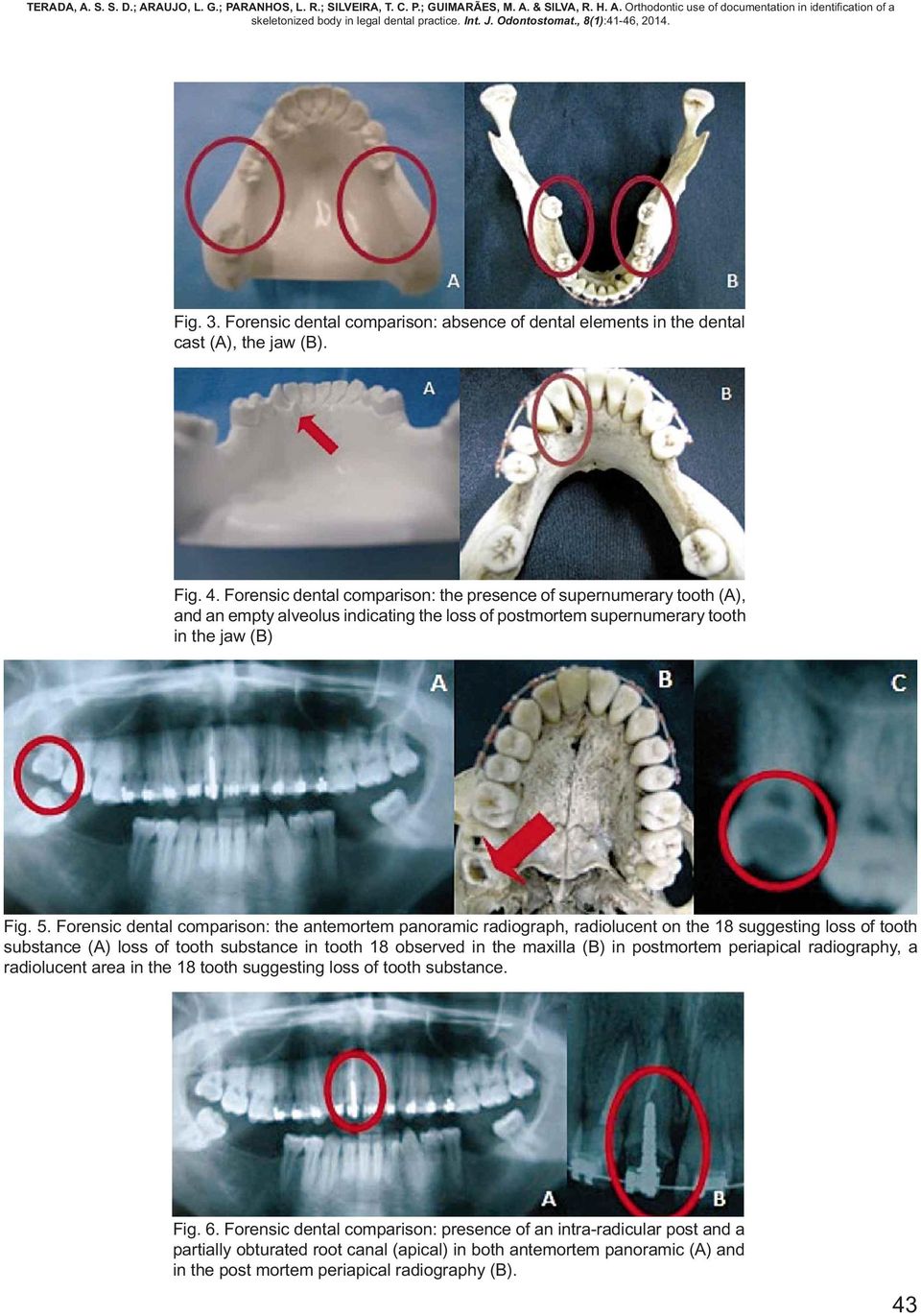 Forensic dental comparison: the antemortem panoramic radiograph, radiolucent on the 18 suggesting loss of tooth substance (A) loss of tooth substance in tooth 18 observed in the maxilla (B) in