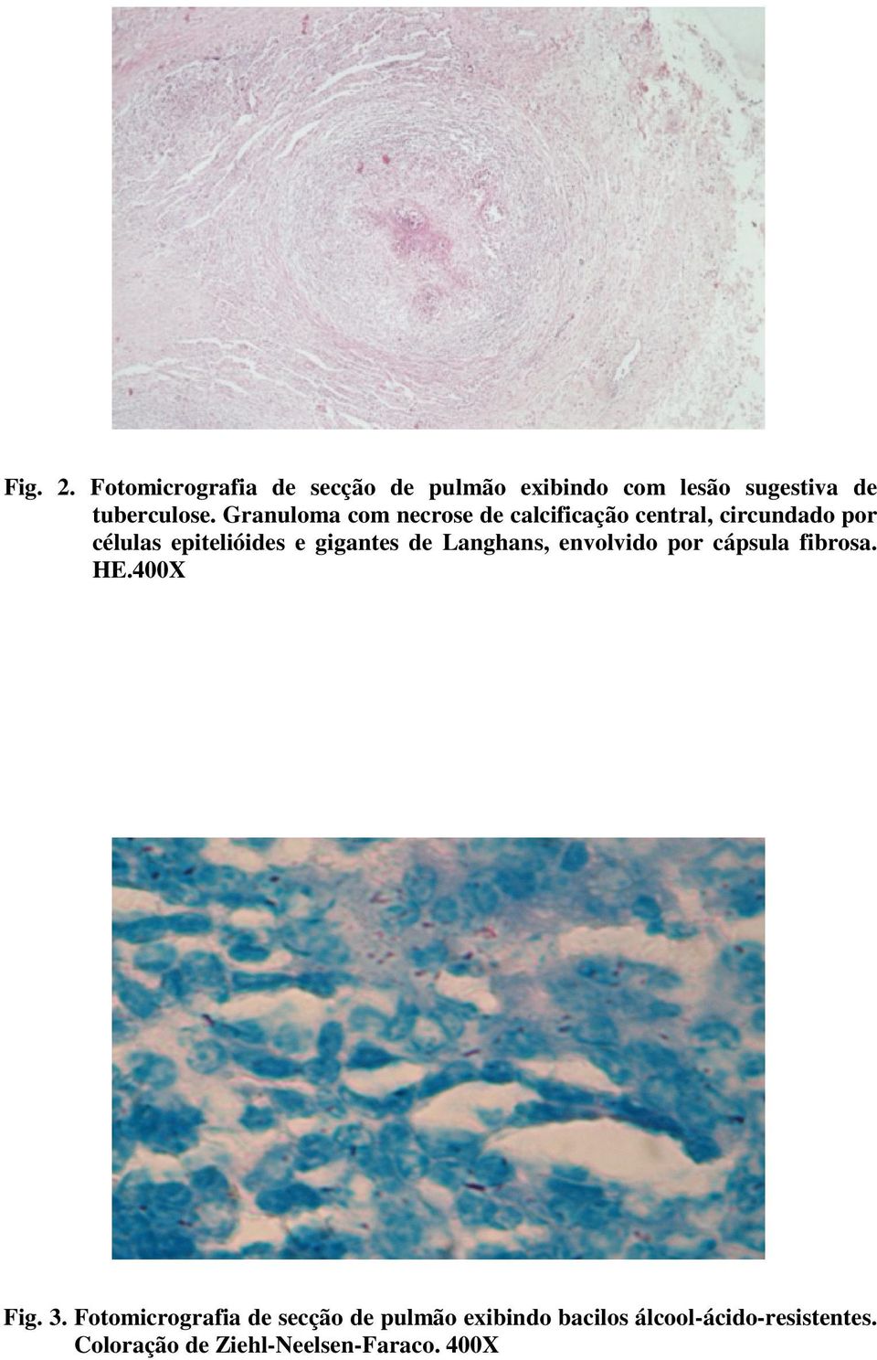 gigantes de Langhans, envolvido por cápsula fibrosa. HE.400X Fig. 3.