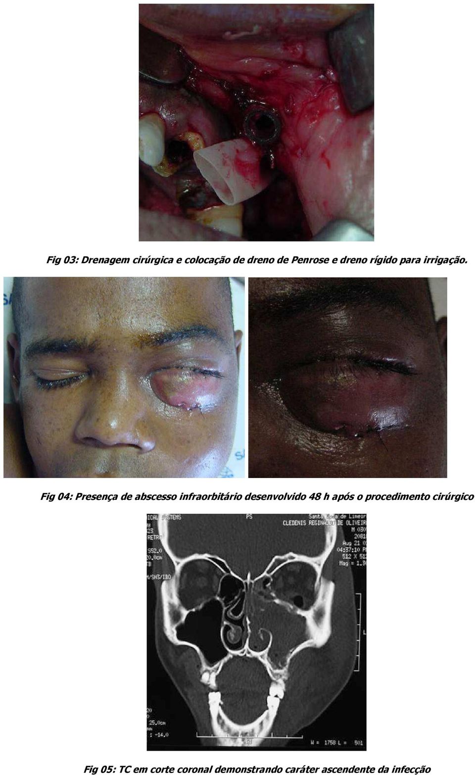 Fig 04: Presença de abscesso infraorbitário desenvolvido 48 h