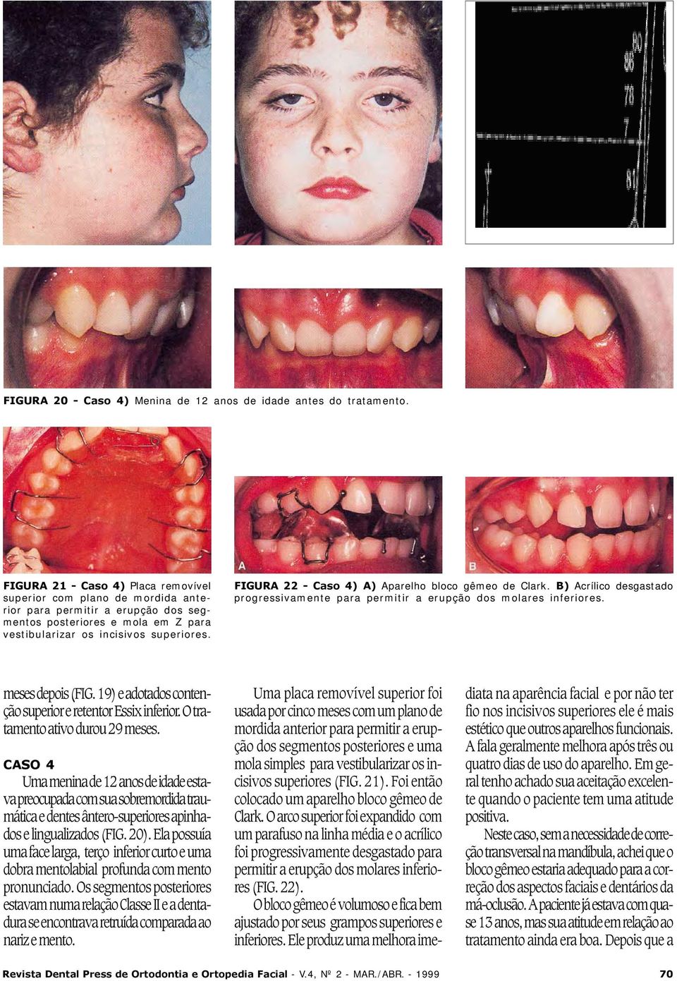 FIGURA 22 - Caso 4) A) Aparelho bloco gêmeo de Clark. B) Acrílico desgastado progressivamente para permitir a erupção dos molares inferiores. meses depois (FIG.