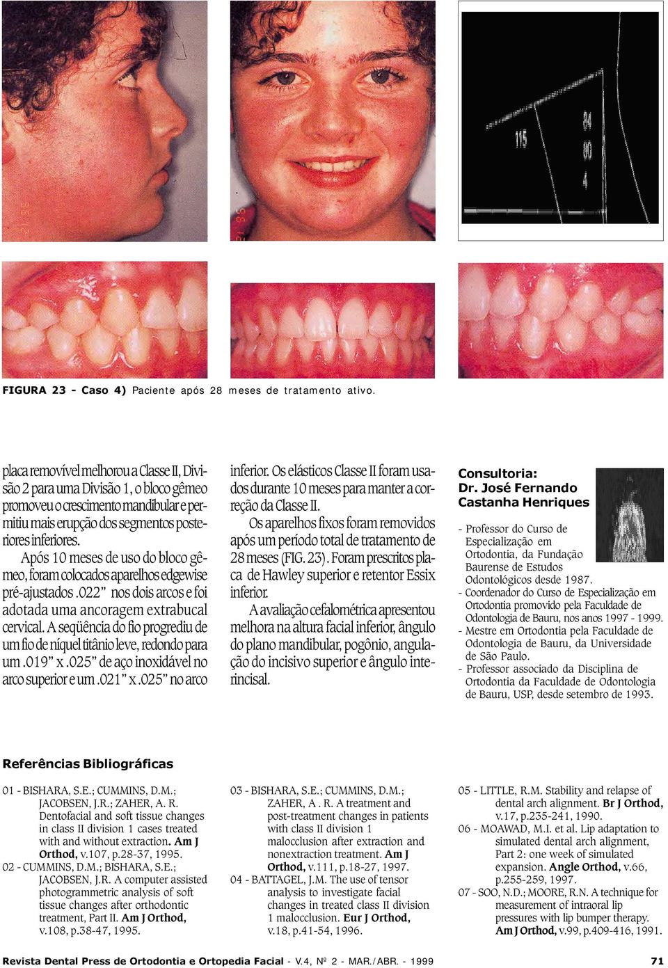 Após 10 meses de uso do bloco gêmeo, foram colocados aparelhos edgewise pré-ajustados.022 nos dois arcos e foi adotada uma ancoragem extrabucal cervical.