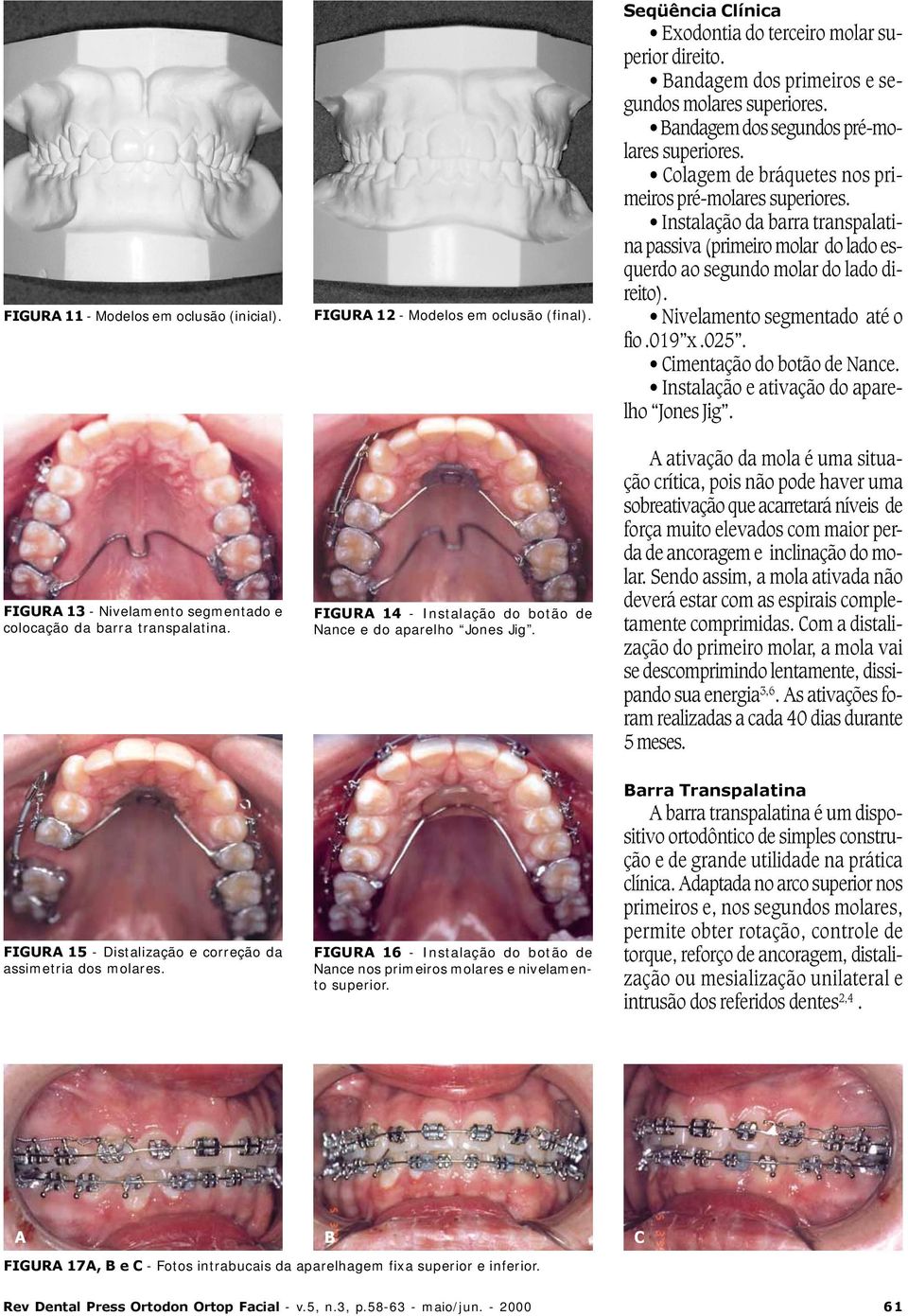 Instalação da barra transpalatina passiva (primeiro molar do lado esquerdo ao segundo molar do lado direito). Nivelamento segmentado até o fio.019 x.025. Cimentação do botão de Nance.