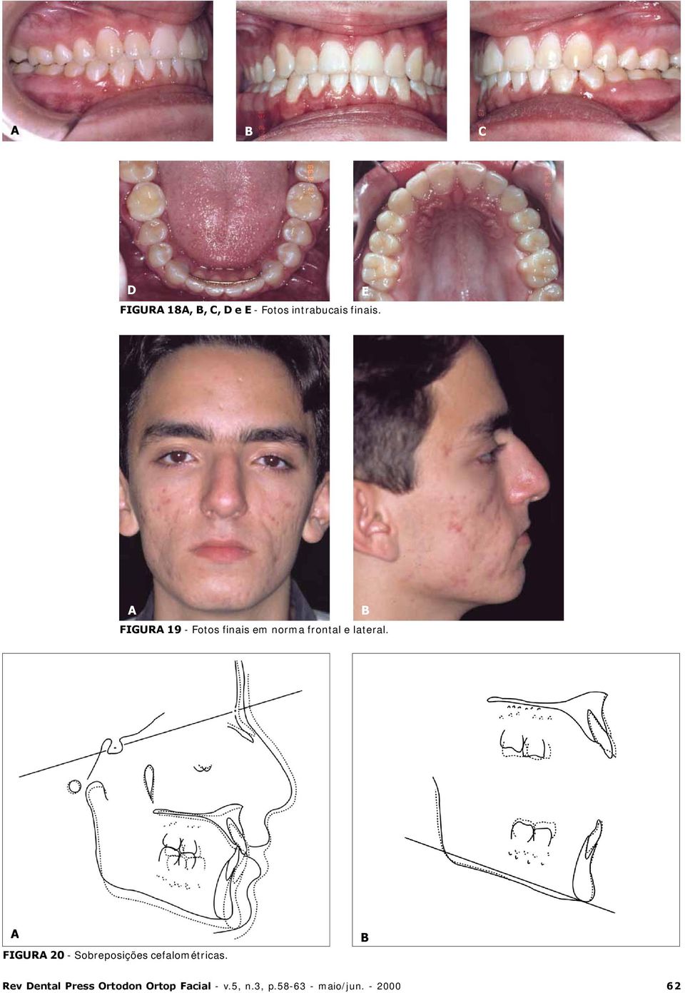 FIGUR 20 - Sobreposições cefalométricas.