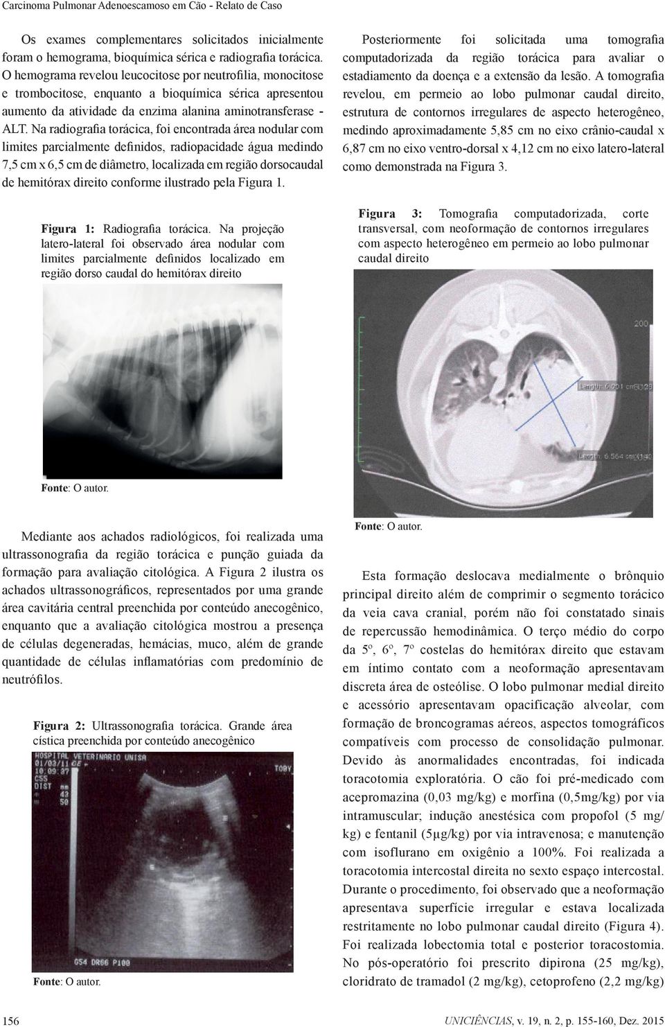 Na radiografia torácica, foi encontrada área nodular com limites parcialmente definidos, radiopacidade água medindo 7,5 cm x 6,5 cm de diâmetro, localizada em região dorsocaudal de hemitórax direito