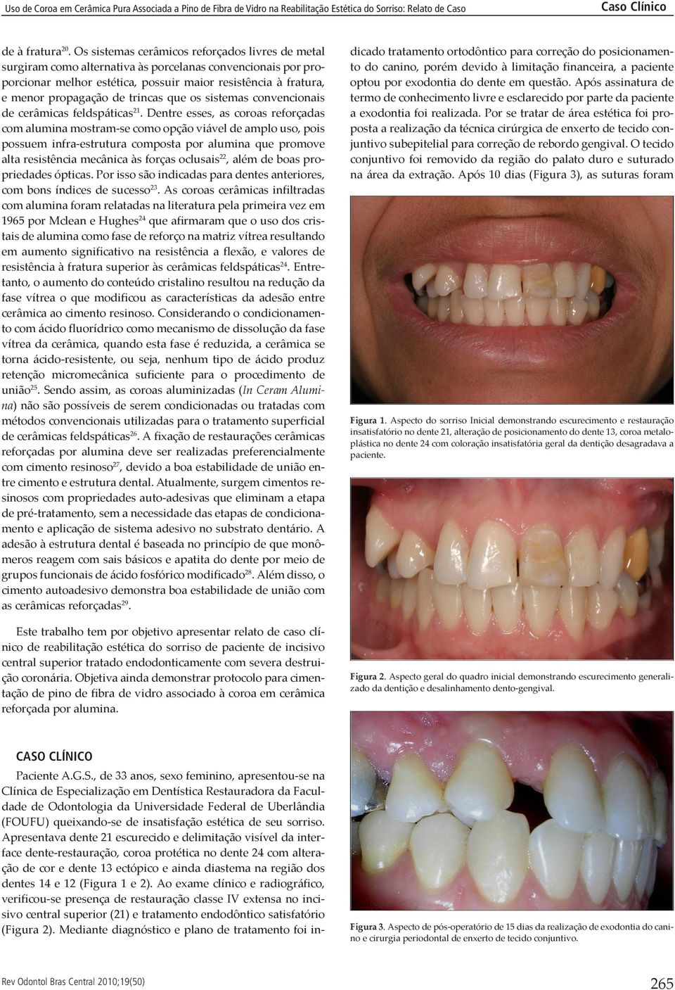 trincas que os sistemas convencionais de cerâmicas feldspáticas 21.