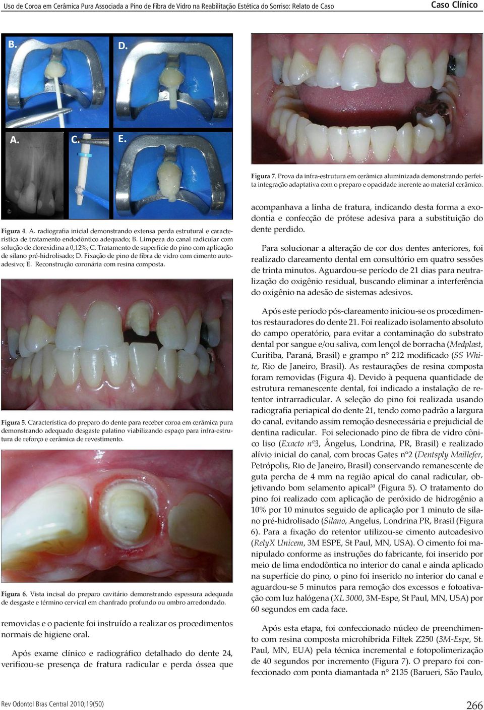 Tratamento de superfície do pino com aplicação de silano pré-hidrolisado; D. Fixação de pino de fibra de vidro com cimento autoadesivo; E. Reconstrução coronária com resina composta. Figura 5.