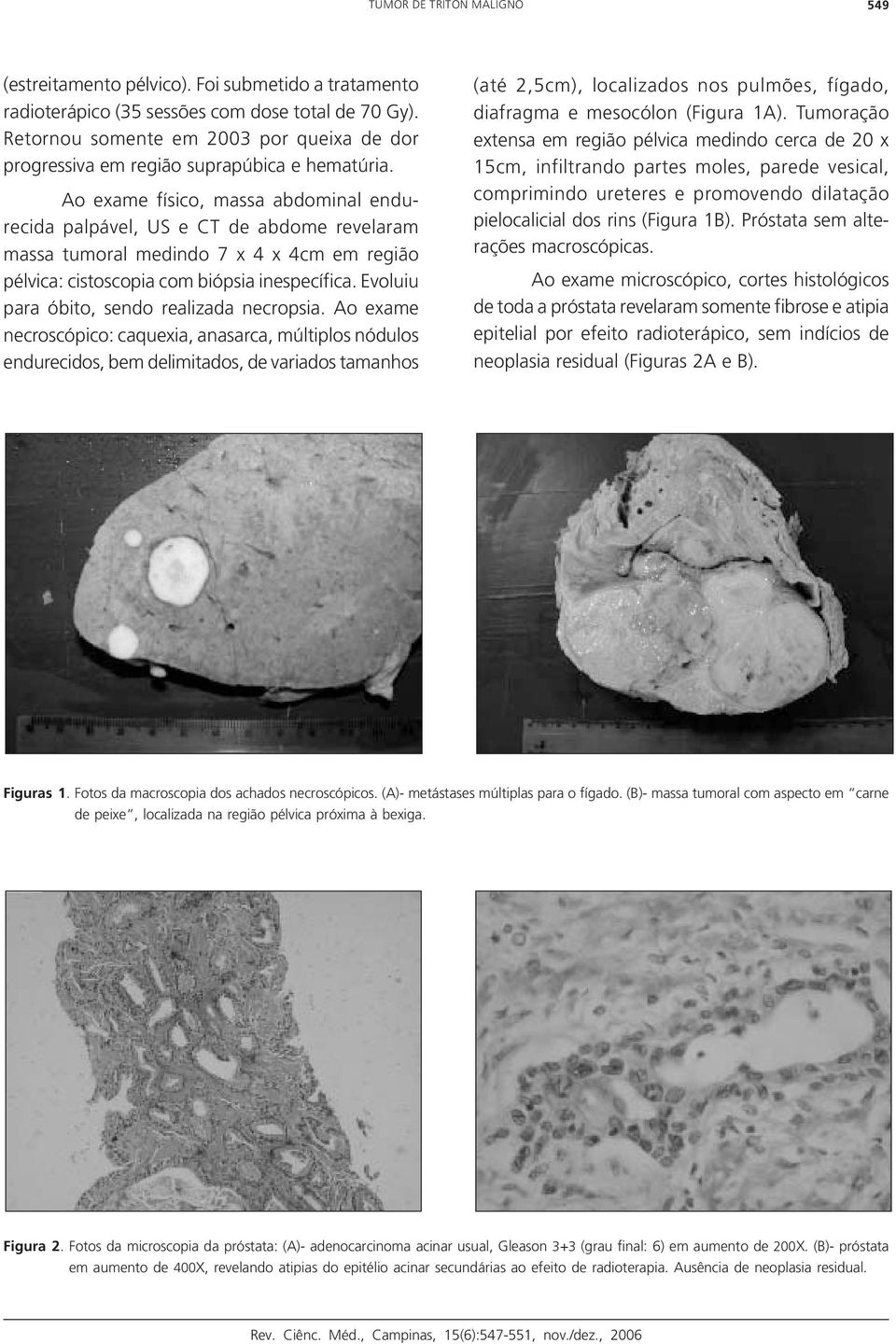 Ao exame físico, massa abdominal endurecida palpável, US e CT de abdome revelaram massa tumoral medindo 7 x 4 x 4cm em região pélvica: cistoscopia com biópsia inespecífica.