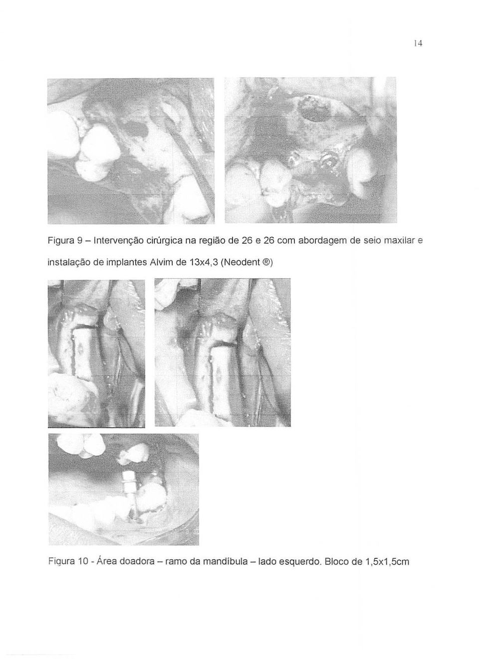 implantes Alvim de 13x4,3 (Neodent ) Figura 10 - Area